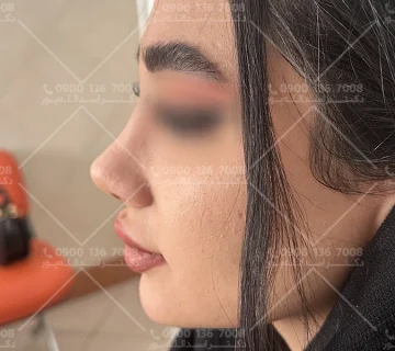 فیلم عمل بینی دکتر اسدالله پور جراح قائمشهری